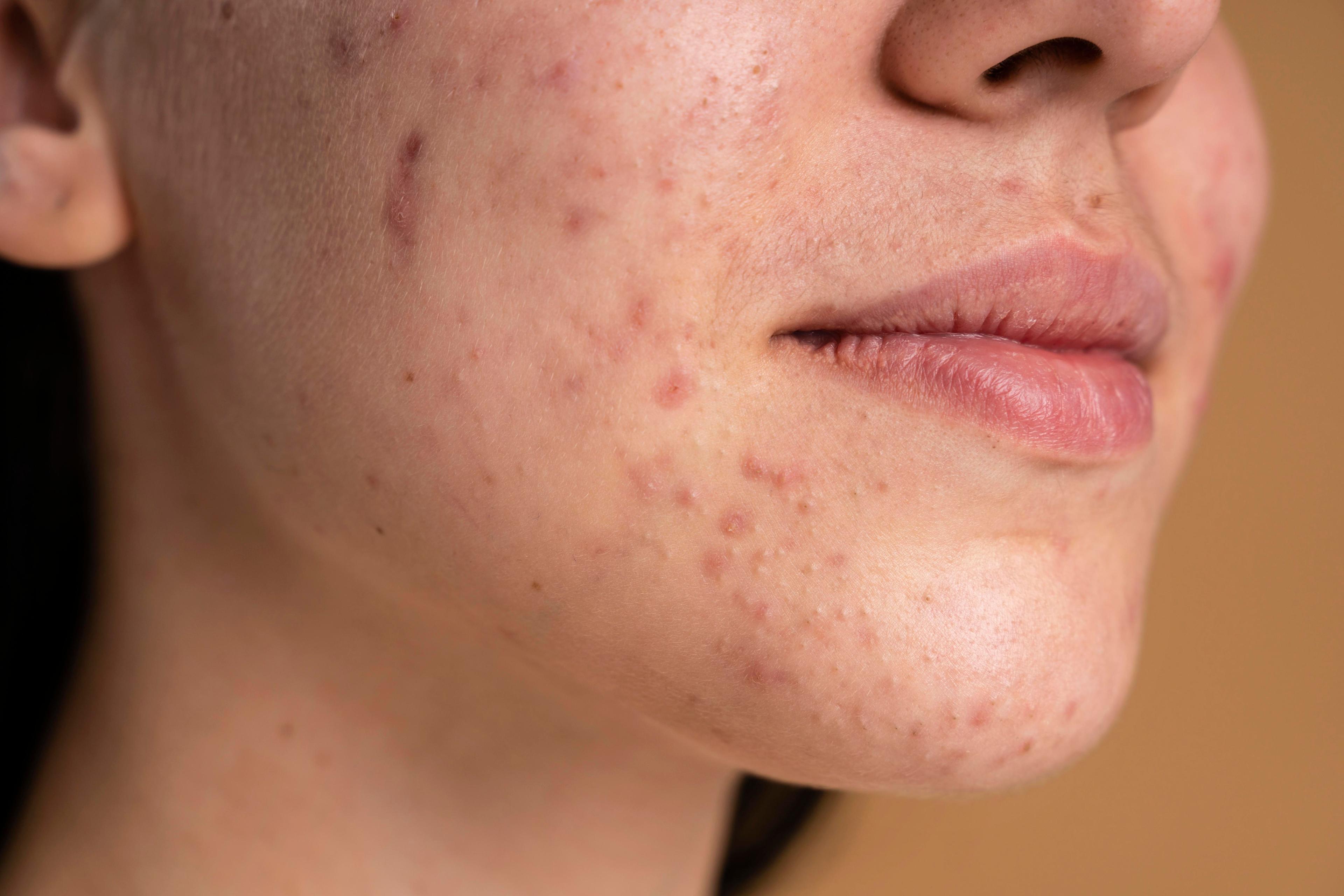 confident-young-woman-with-acne-close-up (1).jpg